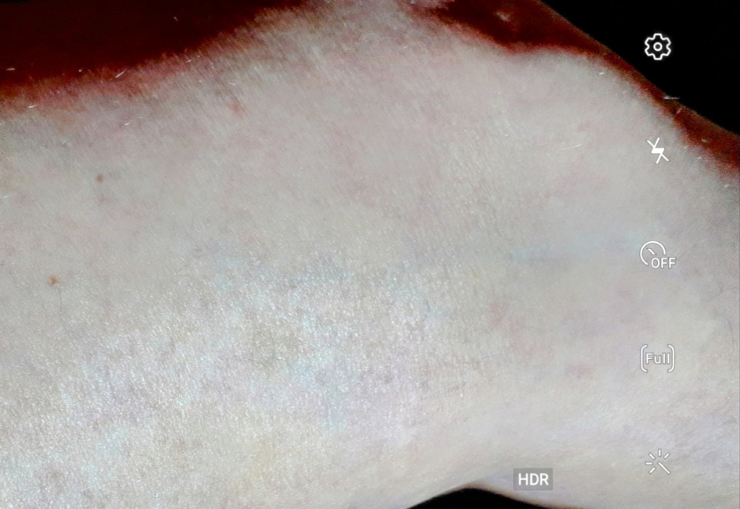 Ann98897110's tweet photo. So it seems they are hitting the femoral vein , will cause  thrombosis,  circulatory circulation. https://t.co/JtqLLs7sHr