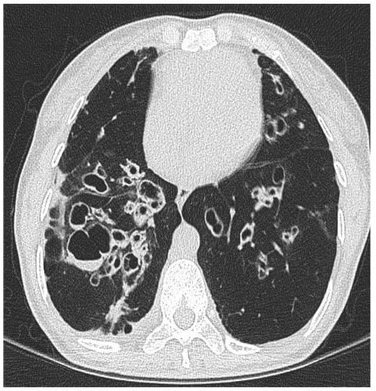 I enjoyed this review on personalized medicine for bronchiectasis - just published from colleagues at the Royal Brompton Hospital
#precisionmedicine #treatabletraits
mdpi.com/2075-4426/13/1…