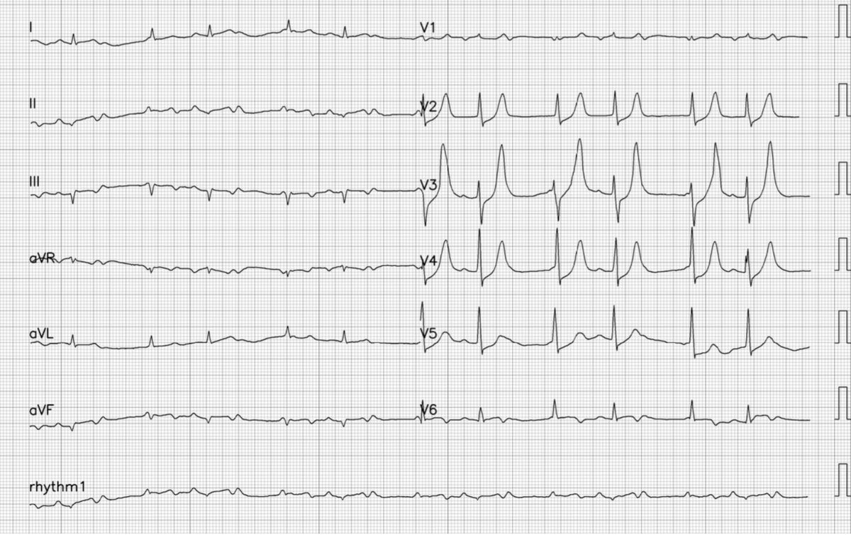 Silva_J_Carlos's tweet photo. Male, chest pain. What do you think? #FOAMed #ECG #ecglearning #ecgeducation #Cardiotwitter #Cardiology App @PMcardioBot @RobertHermanMD https://t.co/cvq2cJKqdd