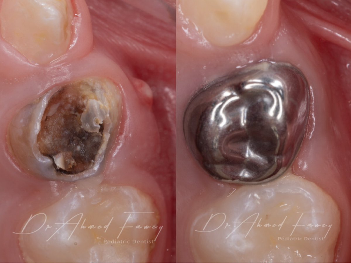 drfawzydentist's tweet photo. علاج الخراج في الضروس اللبنية مش ضروي يكون الخلع…ممكن علاج العصي ثم تغطية الضرس وحمايته من الكسر بكراون مخصص للضروس اللبنية..الصورة لطفل ٣ سنوات بعد اسبوعين من العلاج https://t.co/ed8flnjRff
