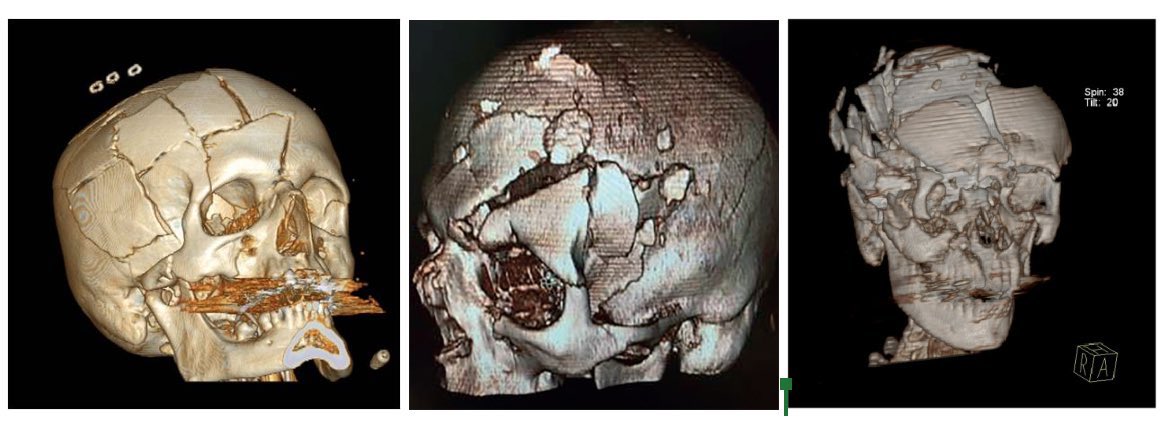 DrDineshGora's tweet photo. 3 reasons to wear Helmet.
#Neurotrauma 
Your safety in your hands.
#RoadSafetyWeek2023 https://t.co/bD62ieEXvl