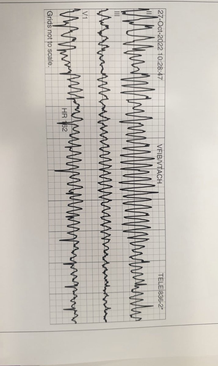 Ghilzai_MD's tweet photo. @MichaelLiuMD @ecgrhythms Looks like an artifact, We had a Pt having Parkinson tremors, attached is his tele https://t.co/3E4XbmOWkV
