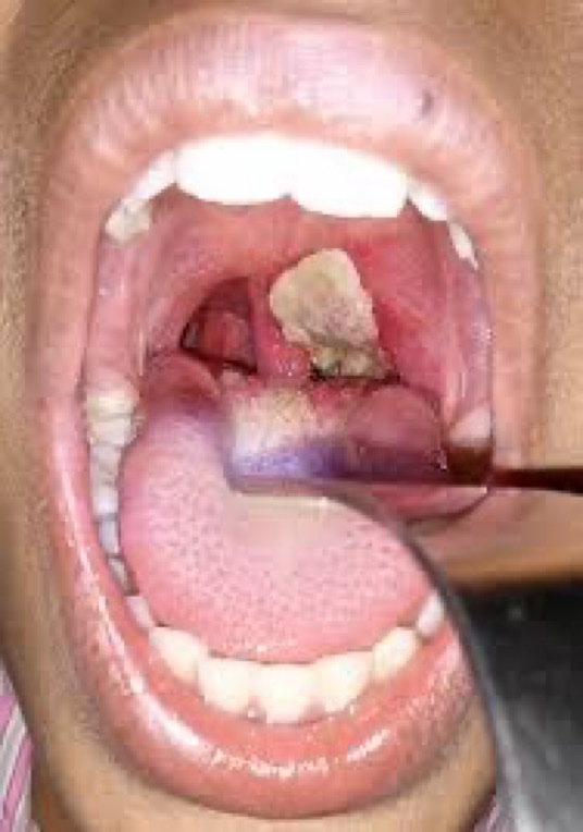 BrownJHM's tweet photo. A young unvaccinated patient presented with fever, sore throat, barking cough &amp; hoarseness for 5 days. Gram stain w/gram + pleomorphic bacillus. What is the likely diagnosis? (Image: Wikipedia) #Medtwitter https://t.co/X3APDrZOJR