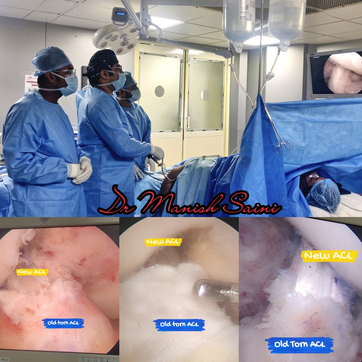 DManishsaini's tweet photo. Preserving the remnant in ACL reconstruction surgery have potential benefits.The proprioceptive structures of the distal tibial remnant contributes to faster graft innervation leading to a better proprioception.
#arthrex
#smithandnephew
@ISAKOS
@ArthroscopyJ
@shalbyhospitals https://t.co/Ts05lHdqc6