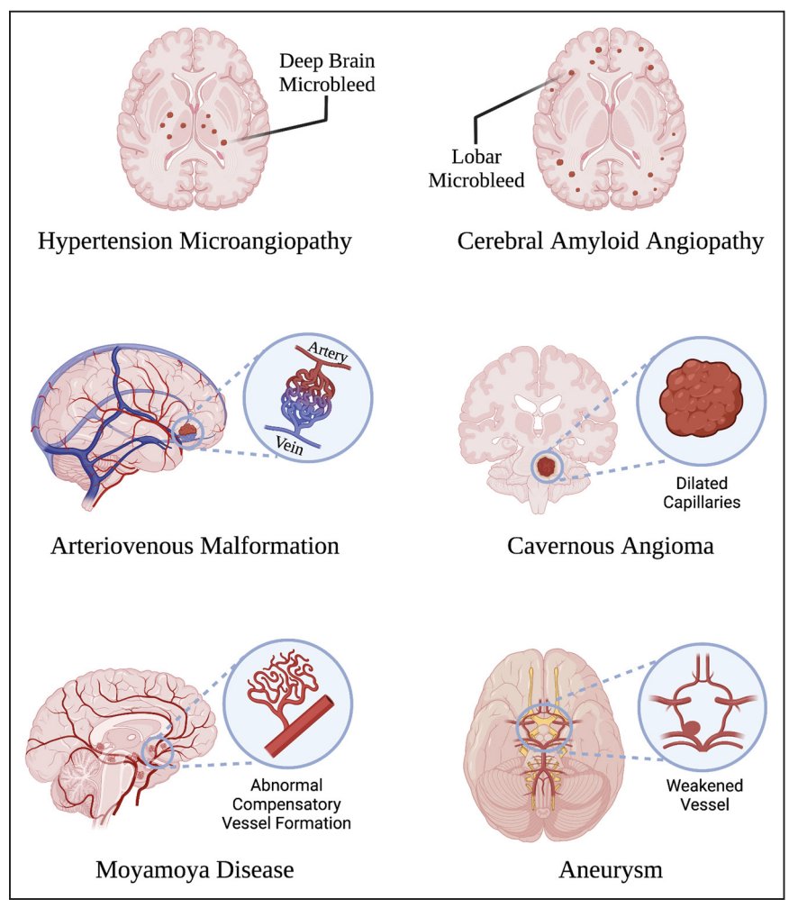 🩸🧠Common causes of Intracerebral Hemorrhage

via <a href="/CircRes/">Circulation Research</a> 2022 Apr 15;130(8):1204-1229

#MedTwitter #MedStudentTwitter #MedEd #FOAMed
#neurotwitter #Neurology #stroke #Neurosurgery  #EndNeurophobia
 #FOAMrad #NeuroRad #neuroradiology #radiology #radres #RadEd #FOAMncc #MRI
