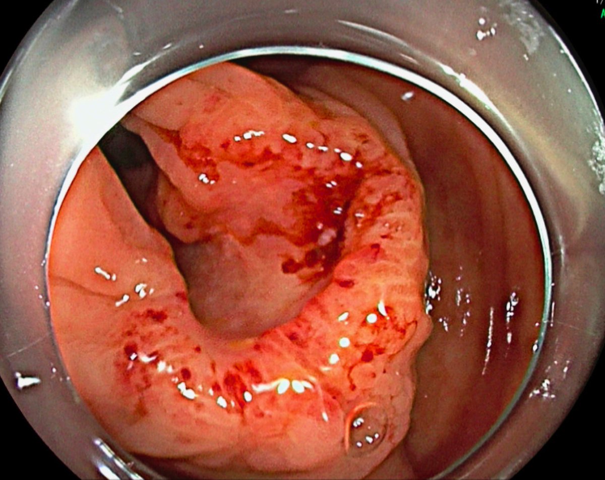 JJFordeMD's tweet photo. ENDOSCOPIC RESECTION IS ALL OR NOTHING! Below is a colonic lesion with prior failed resection attempt. The path read TVA with HGD. The patient presented one year after initial attempt to have the remaining lesion removed. (Shared with permission) #GITwitter https://t.co/VOgQ4hofXk