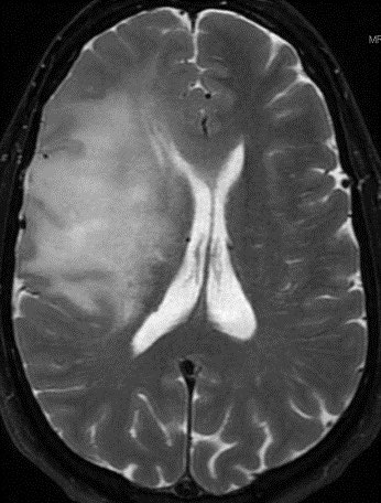 daniel_gewolb's tweet photo. Tumor? Or Tumefactive Demyelination? Can you figure it out? Patient is a 55 y/o M with no PMH. 

Additional images in thread.
Answer in a few hours. 🧠
#Neurology #Neurosurgery #radres #MedTwitter @TheASNR https://t.co/BXsHYP5grG