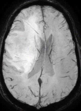 daniel_gewolb's tweet photo. Tumor? Or Tumefactive Demyelination? Can you figure it out? Patient is a 55 y/o M with no PMH. 

Additional images in thread.
Answer in a few hours. 🧠
#Neurology #Neurosurgery #radres #MedTwitter @TheASNR https://t.co/BXsHYP5grG