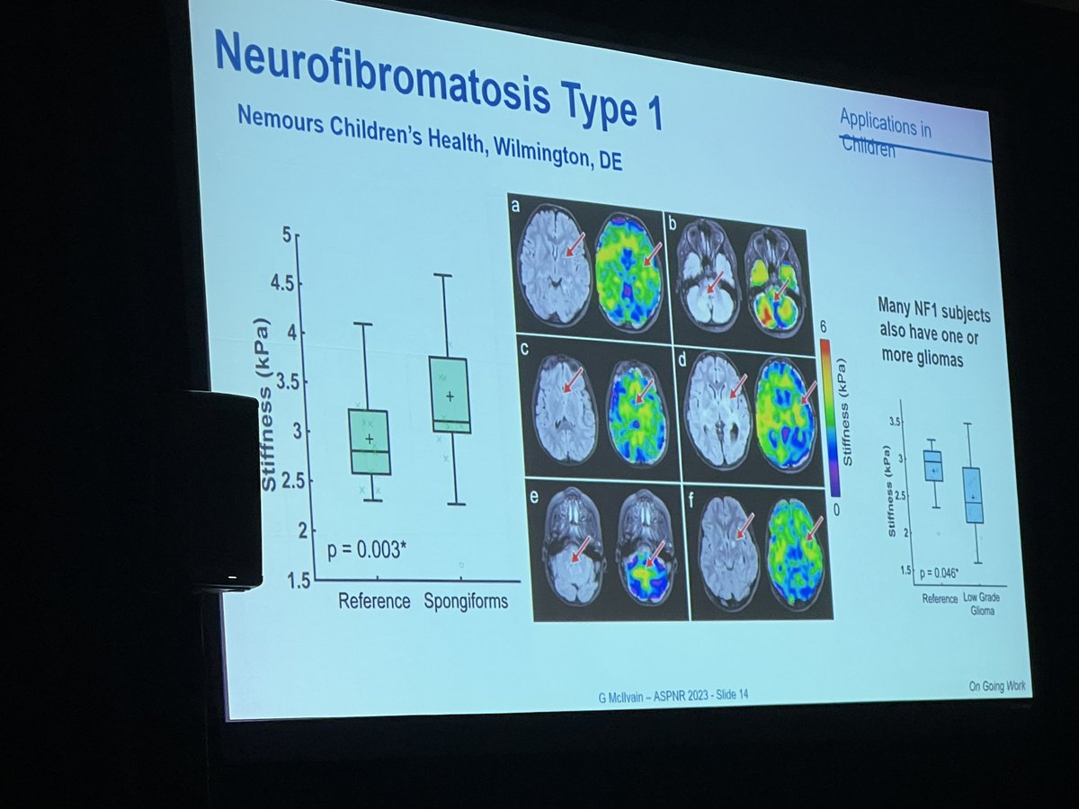 Laura Hayes (@laura1127md) on Twitter photo Brilliant talk by Dr. <a href="/gracemcilvain/">Grace McIlvain</a> at #ASPNR23 on MR Elastography of the Brain. Especially excited for using it as a tool for imaging gliomas. @Emory <a href="/NemoursRads/">Nemours Radiology</a> Brilliant talk by Dr. <a href="/gracemcilvain/">Grace McIlvain</a> at #ASPNR23 on MR Elastography of the Brain. Especially excited for using it as a tool for imaging gliomas. @Emory <a href="/NemoursRads/">Nemours Radiology</a>