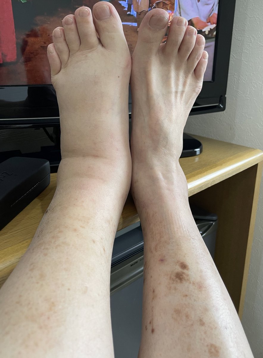 tyushoken's tweet image. 西浦の「💉💉打たなかったら大切な人が死ぬぞ」で脅されて1セットやっちまった組です😭😭
帯状疱疹と左下肢浮腫で身の危険を感じて止めました。