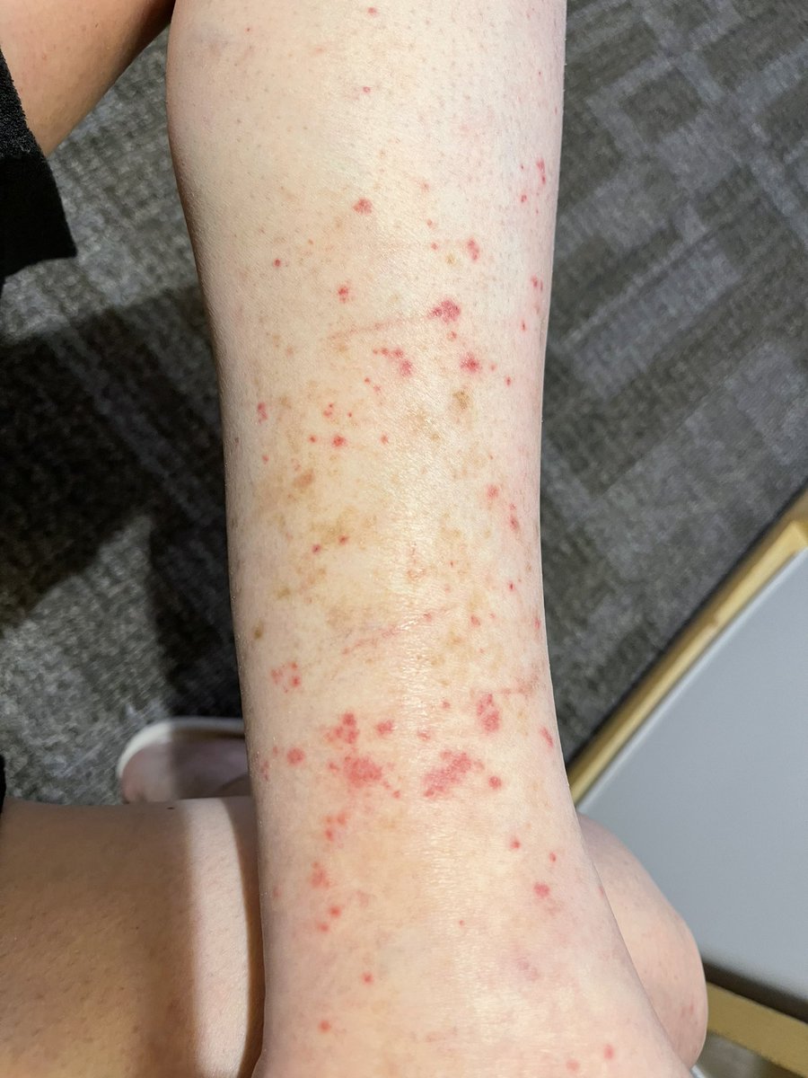 tyushoken's tweet image. 西浦の「💉💉打たなかったら大切な人が死ぬぞ」で脅されて1セットやっちまった組です😭😭
帯状疱疹と左下肢浮腫で身の危険を感じて止めました。