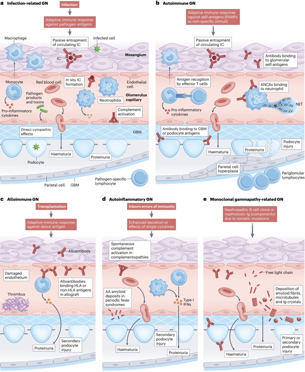 The Innovation | Medicine (@innov_medicine) on Twitter photo Glomerulonephritis: immunopathogenesis and immunotherapy <a href="/NatRevImmunol/">Nature Rev Immunol</a>
nature.com/articles/s4157…
Simplified schematic of the pathogenesis of the five categories of glomerulonephritis Glomerulonephritis: immunopathogenesis and immunotherapy <a href="/NatRevImmunol/">Nature Rev Immunol</a>
nature.com/articles/s4157…
Simplified schematic of the pathogenesis of the five categories of glomerulonephritis