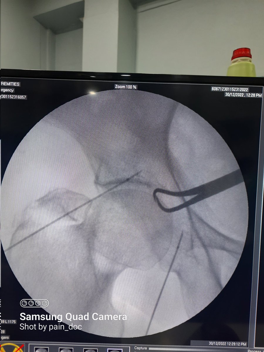 abhisesh's tweet photo. Hip Radiofrequency Ablation secondary to carcinoma cervix under fluroscopic guidance https://t.co/oLZ6s2S6F9