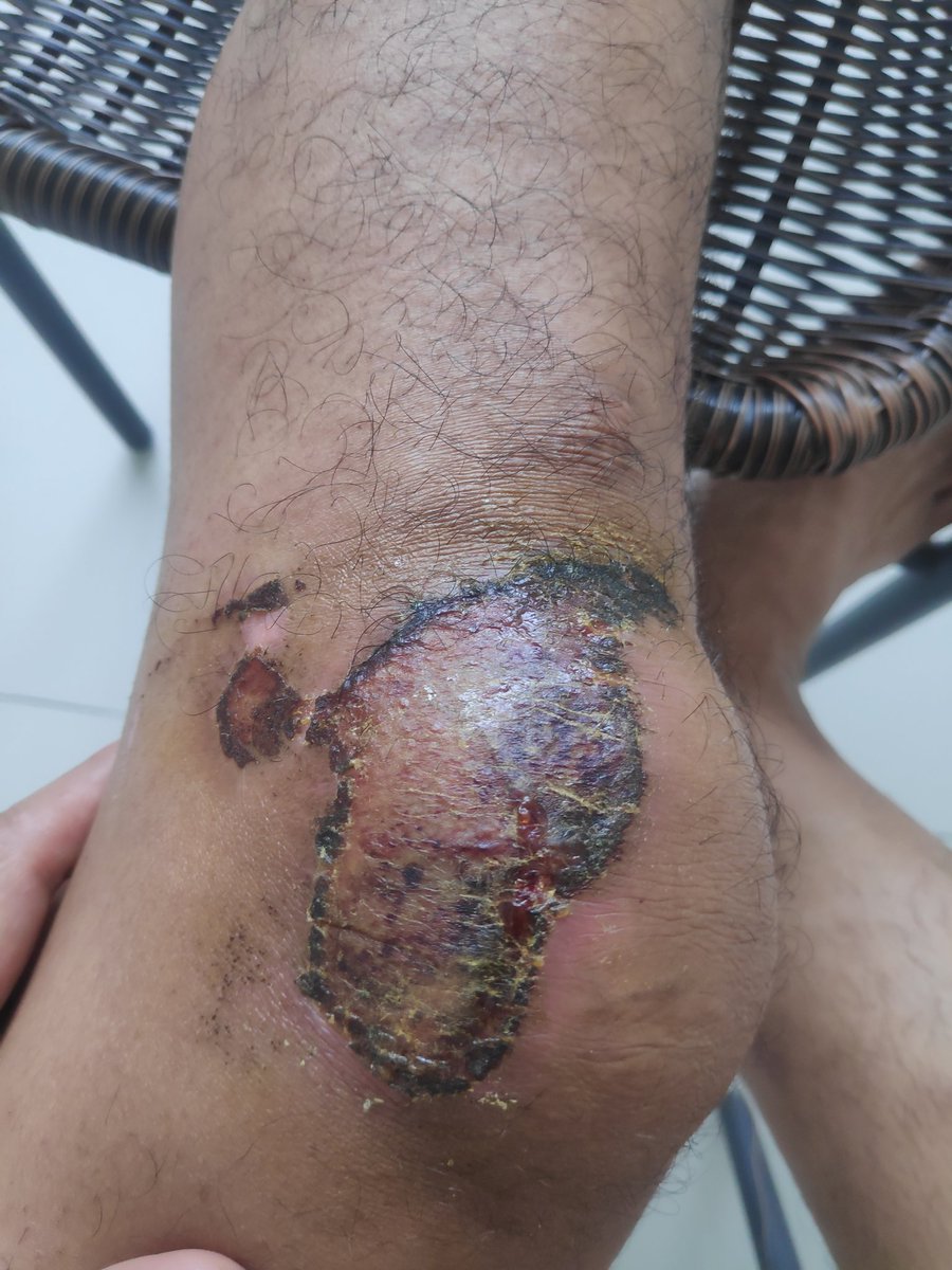 Hari ke 8 luka udah mulai kering