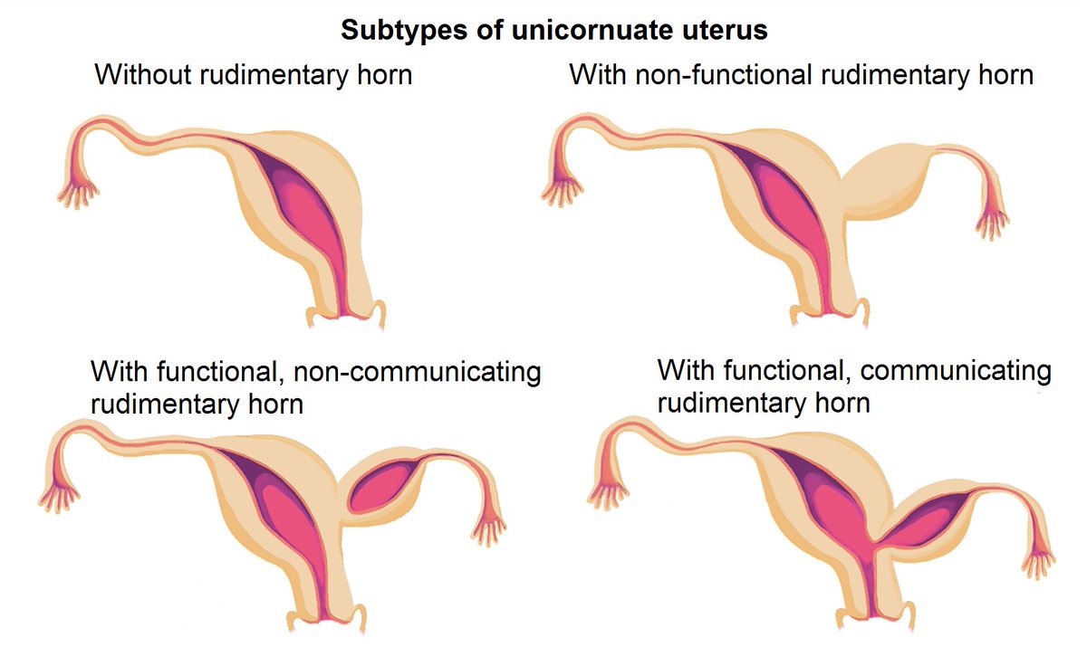 January #freeaccess #UOGJournal article by Tellum et al. describes the reproductive outcome in 326 women with unicornuate uterus bit.ly/3Woeni1 #ISUOG #LoveUltrasound <a href="/WileyHealth/">Wiley Clinical and Health</a>