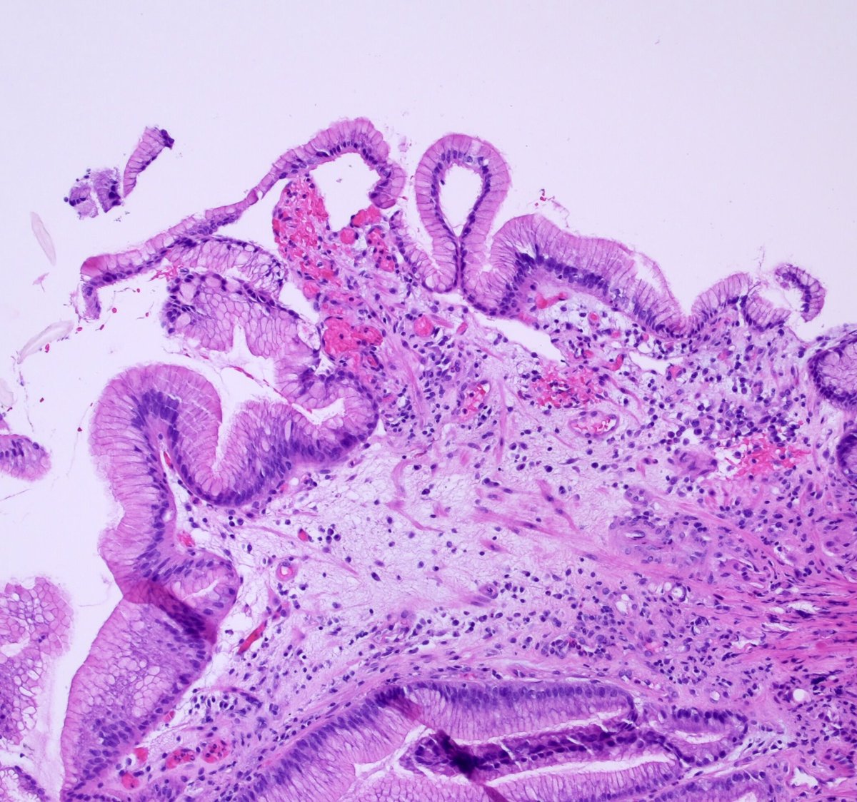 Teclis82's tweet photo. #GIPath #Surgpath #Pathresidents #Pathtwitter

65 Year old female, gastric antral biopsy, rule out H. pylori.

Some pictures, a poll, and a short discussion. https://t.co/ePaEOxplAC