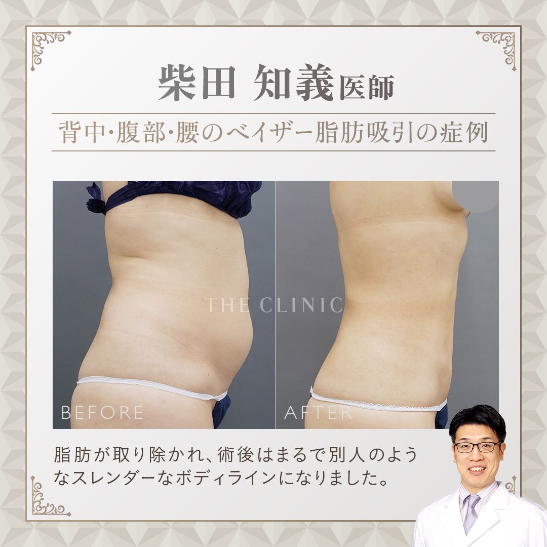 THE CLINIC ザクリニック着圧ガードルLサイズ