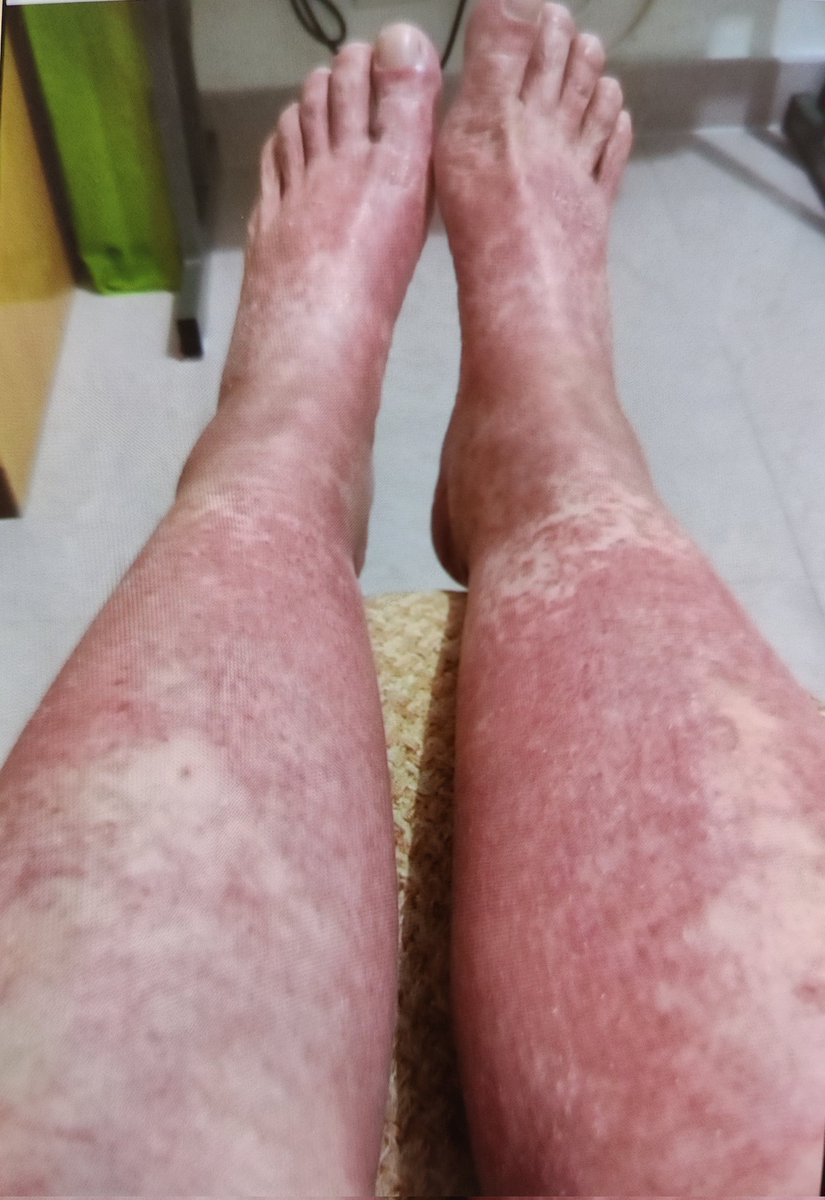 TMPSMX is a versatile antibiotic and a favorite of #IDTwitter , but there are 2 side effects that I fear about

One is hyperK, often due to co-administration with ACEI/ARB 

The other is this ⬇️