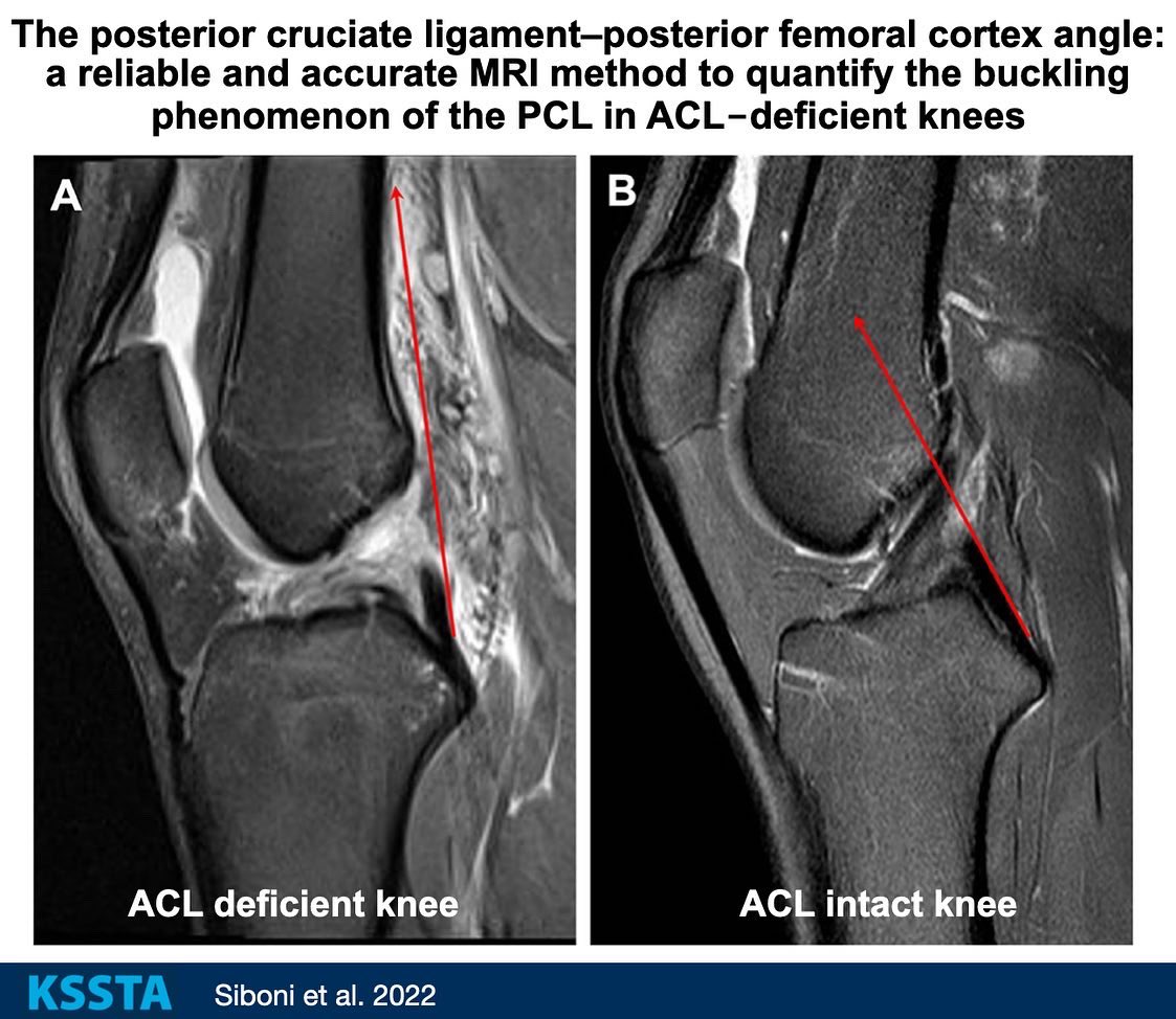 KSSTA's tweet photo. The PCL-PCA method provided the highest precision to measure of the buckling PCL, representative of anterior tibial translation and the best discrimination ACL-deficient and ACL-intact knees

#kneesurgery #ACLrehab #sportsmedicine #radiology

Link: https://t.co/UvRXnsQzuB https://t.co/Cstate0BPp