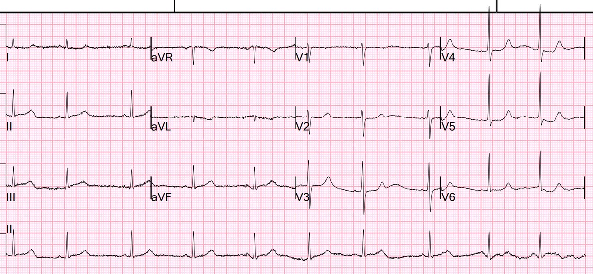 OMI can be very subtle and easy to miss, but be a very large infarction.

hqmeded-ecg.blogspot.com/2023/01/omi-ca…