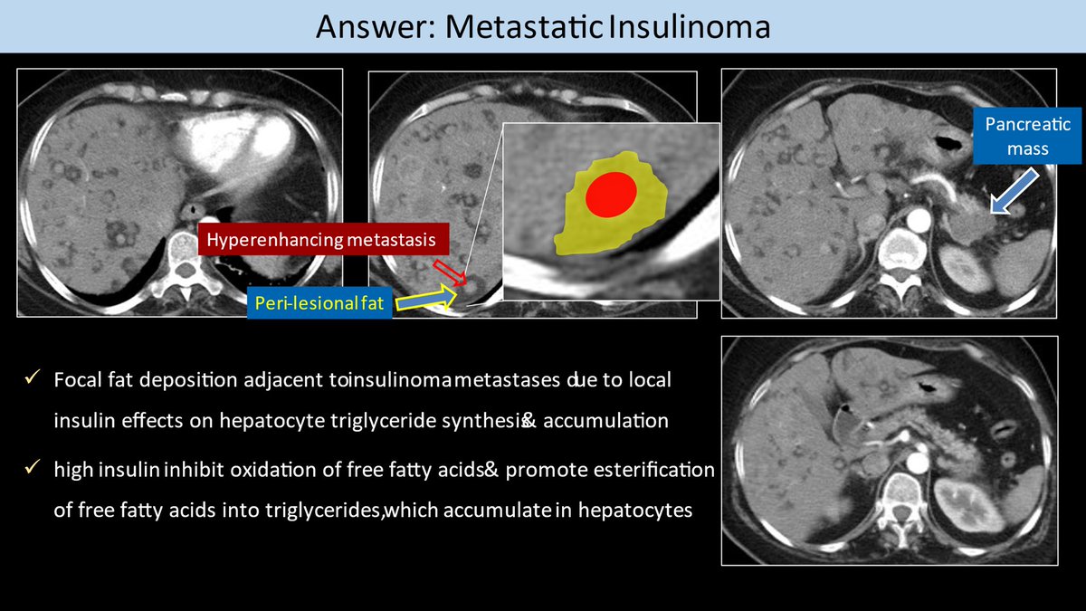 Khaled Elsayes (@elsayeskhaled) on Twitter photo Metastatic insulinoma (Pancreatic Mass + Focal fat deposition adjacent to insulinoma metastases due to local insulin effects on hepatocyte triglyceride synthesis & accumulation
<a href="/AwanRad/">Omer Awan MD MPH</a> <a href="/CasesCookyJar/">Cases From the Cooky Jar</a> <a href="/rssafeed/">Saudi RAD Society</a> <a href="/LIRADS5/">SAR_DFP_HCC</a>
<a href="/ACOREdu/">Academy of Online Radiology Education</a> <a href="/RSNA/">RSNA</a> <a href="/SocietyAbdRad/">Society of Abdominal Radiology | SAR</a> <a href="/ICIS_News/">International Cancer Imaging Society</a> <a href="/ARRS_Radiology/">ARRS</a> Metastatic insulinoma (Pancreatic Mass + Focal fat deposition adjacent to insulinoma metastases due to local insulin effects on hepatocyte triglyceride synthesis & accumulation
<a href="/AwanRad/">Omer Awan MD MPH</a> <a href="/CasesCookyJar/">Cases From the Cooky Jar</a> <a href="/rssafeed/">Saudi RAD Society</a> <a href="/LIRADS5/">SAR_DFP_HCC</a>
<a href="/ACOREdu/">Academy of Online Radiology Education</a> <a href="/RSNA/">RSNA</a> <a href="/SocietyAbdRad/">Society of Abdominal Radiology | SAR</a> <a href="/ICIS_News/">International Cancer Imaging Society</a> <a href="/ARRS_Radiology/">ARRS</a>