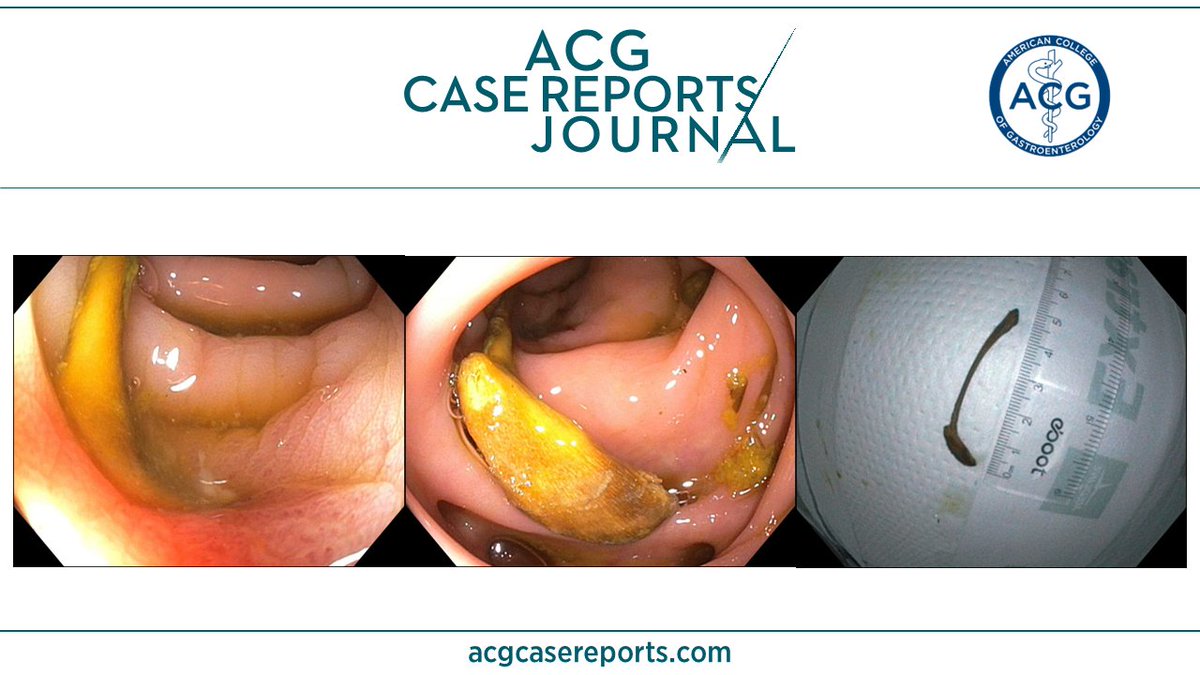 🔎 ACG Case Reports Journal 🔍

Large Chicken Bone Impacted in Colonic Diverticulum Mimicking Diverticulitis
Stoskute, et al.
👉 bit.ly/3ixAJ2B

<a href="/AsimShuja11/">Asim Shuja, MD</a> #GIfellows #GItwitter