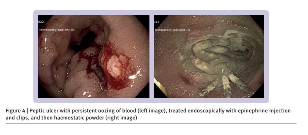 SOMELaguna's tweet photo. Actualización en el Manejo del Sangrado de Tubo Digestivo Alto🩸

🟣Defincion
🔴Epidemilogía
🟡Manejo inicial
🔵Transfusion productos sanguíneos
🟢Riesgo de re-sangrado
🟤Tiempo de la endoscopia
⚪Fármacos
🟠Pronóstico

doi:10.1136/bmjmed-2022-000202

🔓👇
https://t.co/pdXNGVQqPA https://t.co/fSFBq3By3u