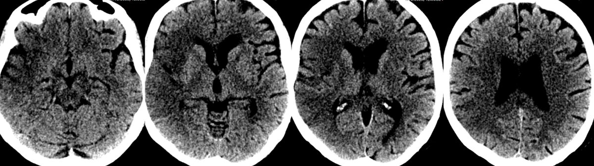 MicieliA_MD's tweet photo. Code Stroke 🧠🚑
70s, mRS 2. Wake up stroke, LSW 11:30pm, found 5:30am with dense L sided weakness, dysarthria. NIHSS 18.

Rads report:
CT - ASPECTS 6
CTA- distal R M1 occlusion

Neuro resident "lets go for EVT, ASPECTS 5 so tissue to save"

What do you do? (can't enrol in trial) https://t.co/aRXdLcBzqS