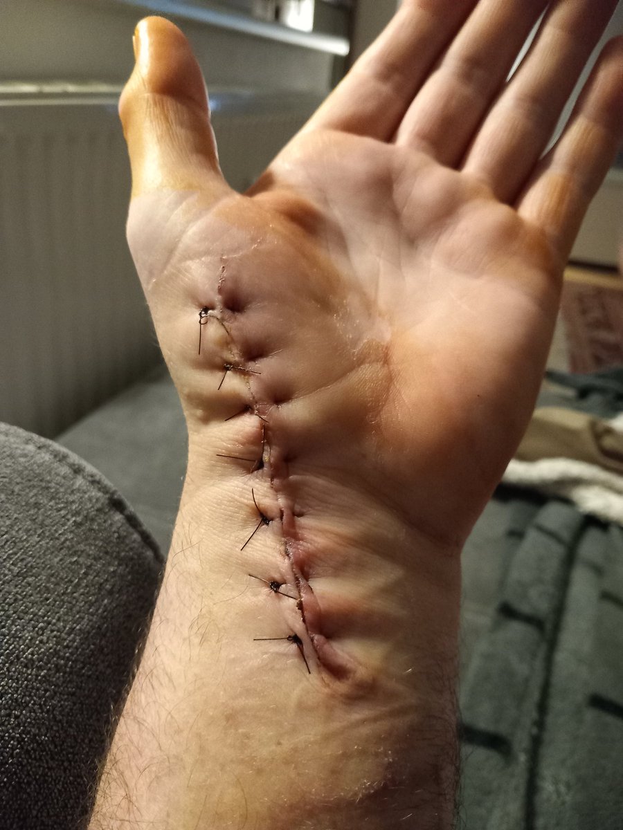 bluekangaroo2's tweet photo. @franhealy Here's my seven stitches on my hand Fran 😂😂would much rather have had your injury 🤷‍♂️ https://t.co/Egf1a8qDz1