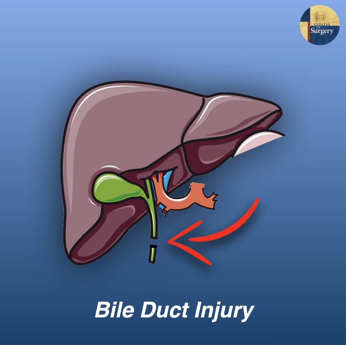 UpdatesSurgery's tweet photo. This study aims to analyze current evidence concerning the safety and the outcomes of the #minimally #invasive approach for biliary anastomosis in post-cholecystectomy Bile Duct Injuries

Full article https://t.co/87qTqKLd2x https://t.co/GWu5Z6jQML