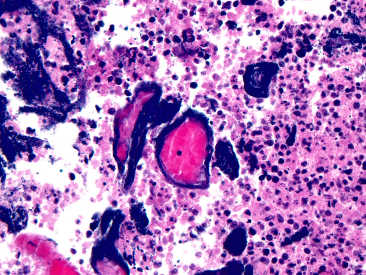 smlungpathguy's tweet image. Azzopardi phenomenon in small cell carcinoma, lung:  kikoxp.com/posts/19742