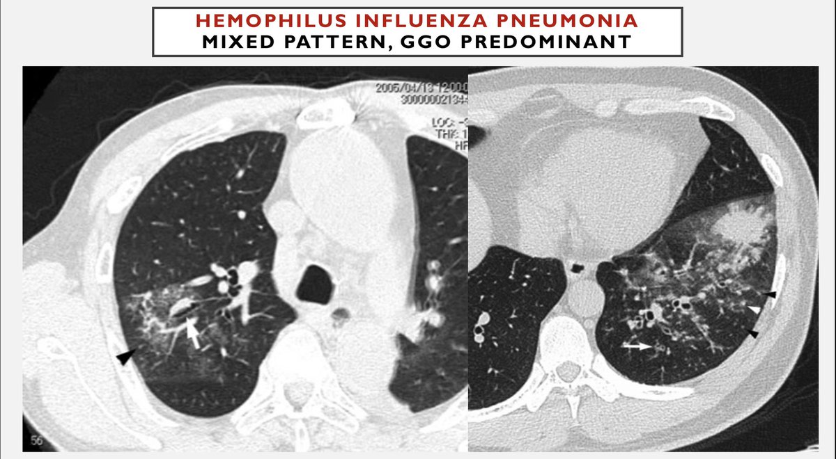 Haemophilus influenzae pneumonia is typical infection but HRCT appearance is more GGO predominant pneumonia similar to atypical infection which is harder to specify among broader differentials including atypical bacteria & viral pneumonias. Can be suggested if on top prior CODP