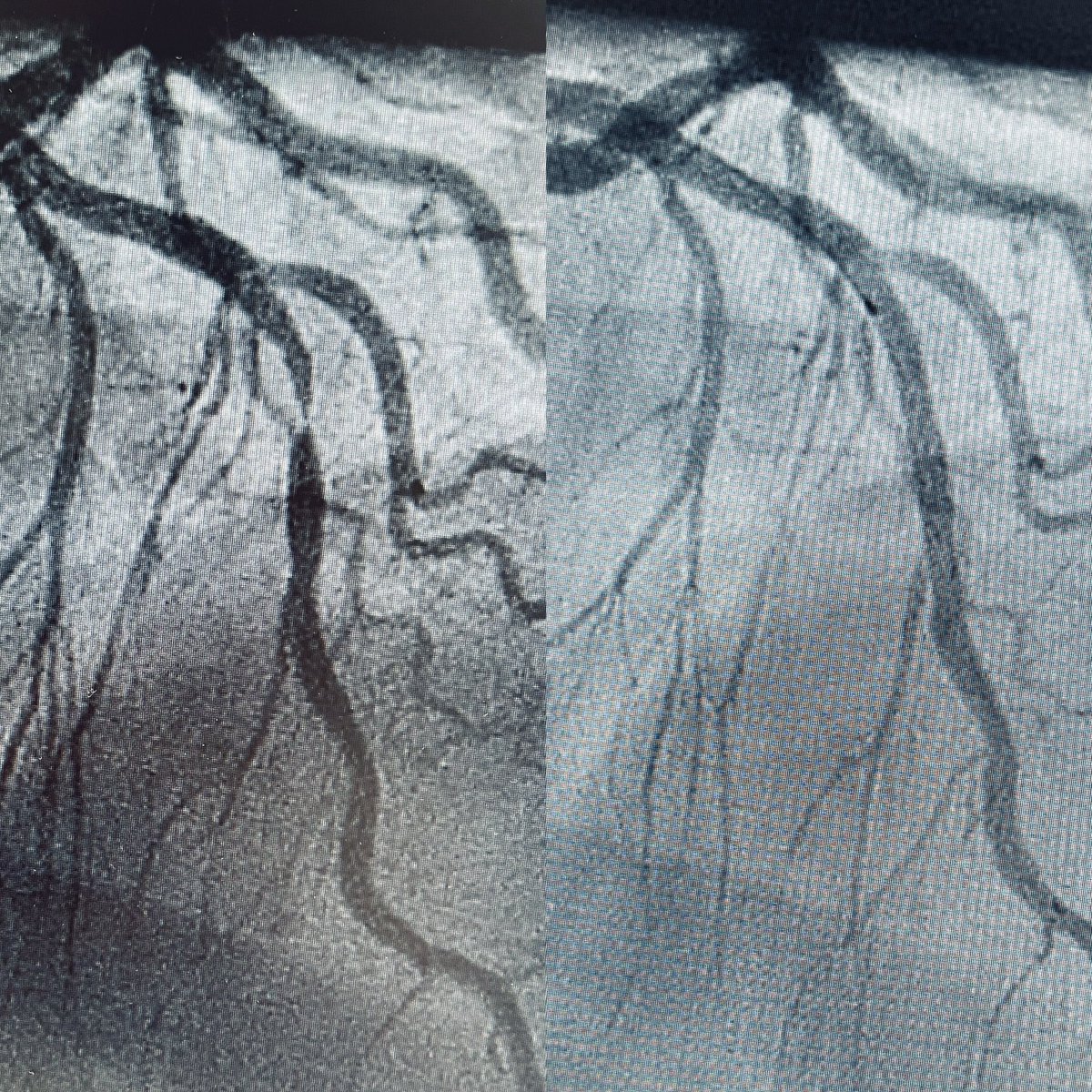 Stent? Noooo, drug coated balloon, of course!