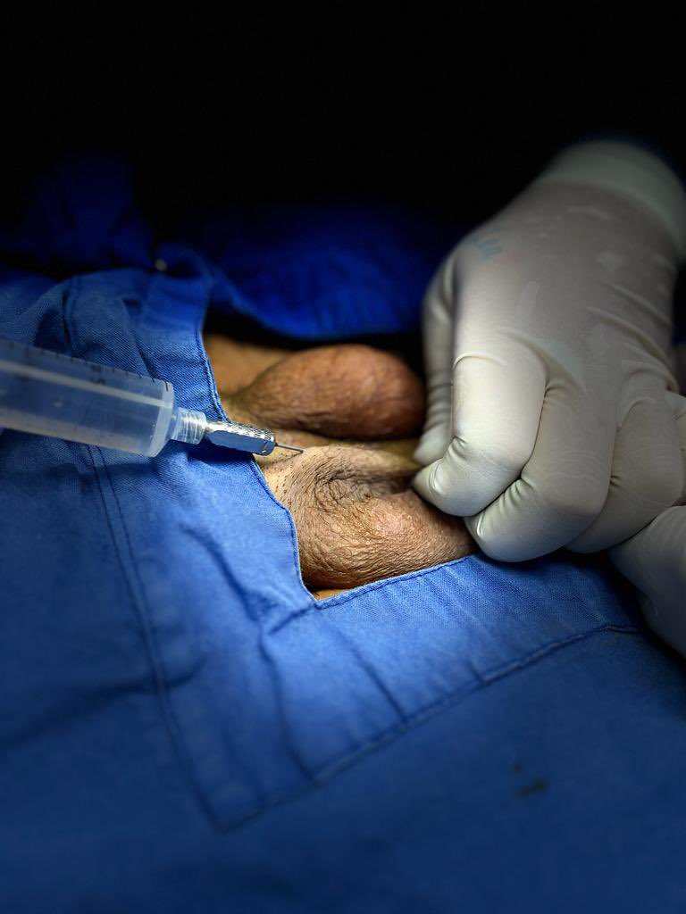 DefinicionC's tweet photo. Les enseñamos un lipo injerto de pene , es un procedimiento indoloro , ambulatorio , si no tienes circuncisión podemos alargar y engrosar , se aplican 30 ml de tu propia grasa y las erecciones son de mejor calidad https://t.co/YJObvpkoa8