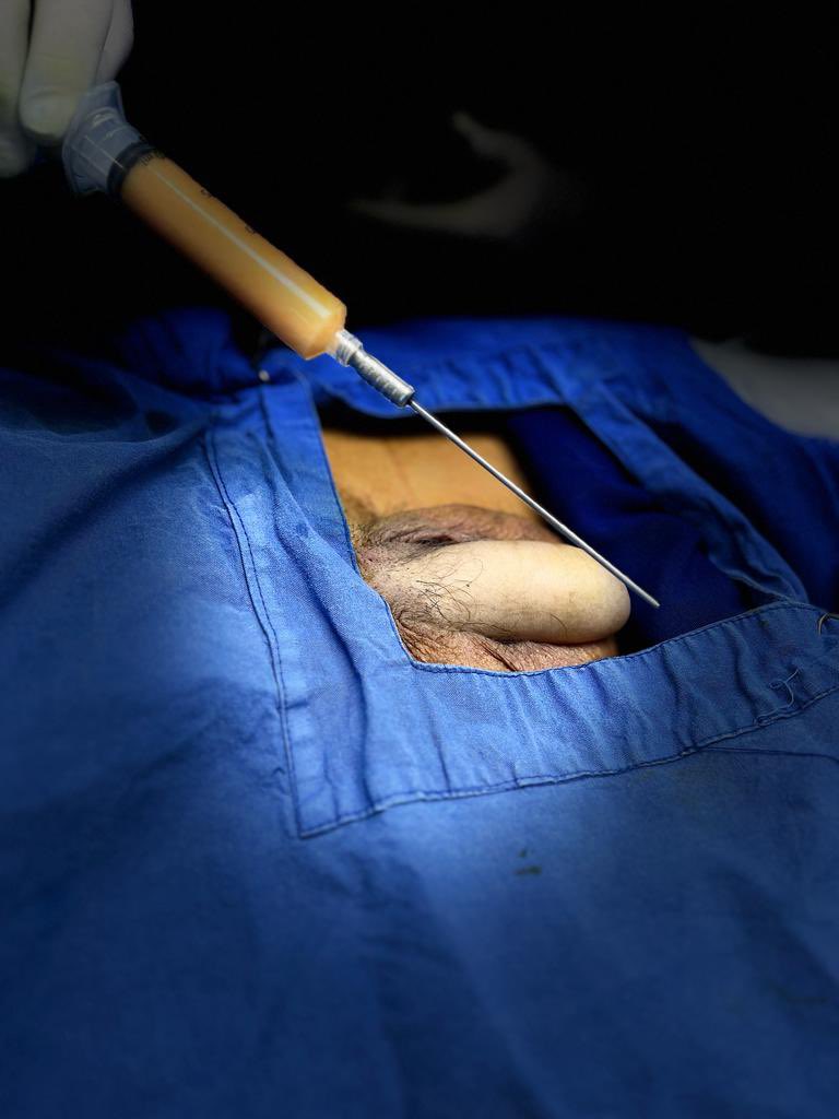 DefinicionC's tweet photo. Les enseñamos un lipo injerto de pene , es un procedimiento indoloro , ambulatorio , si no tienes circuncisión podemos alargar y engrosar , se aplican 30 ml de tu propia grasa y las erecciones son de mejor calidad https://t.co/YJObvpkoa8