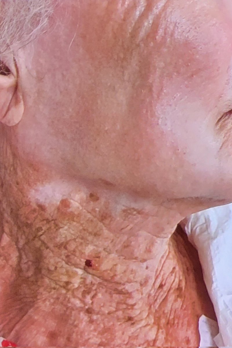 Sarah Stierman MD (@drsarahderm) on Twitter photo Sunscreen is the cheapest and most effective anti-aging cream you can use. Credit to Dr. Lim at <a href="/fallclinical/">Fall Clinical | Winter Clinical</a> #wch23 for sharing this photo of a 92 year old lady who applied sunscreen for years to her face only. 😱😱😱 #wearyoursunscreen #sunscreen #dermatology #MedTwitter #skin Sunscreen is the cheapest and most effective anti-aging cream you can use. Credit to Dr. Lim at <a href="/fallclinical/">Fall Clinical | Winter Clinical</a> #wch23 for sharing this photo of a 92 year old lady who applied sunscreen for years to her face only. 😱😱😱 #wearyoursunscreen #sunscreen #dermatology #MedTwitter #skin