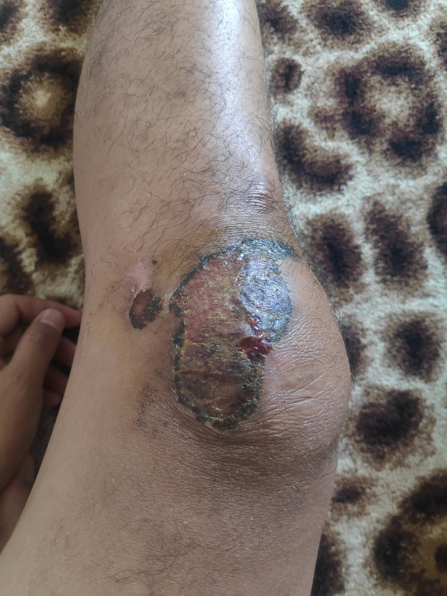 Hari ke 9 lukanya udah mulai ada yg ngelupas dikit2