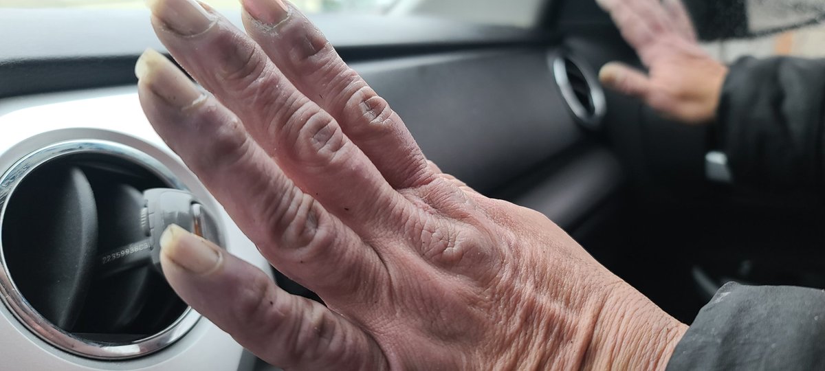 WeInvisible's tweet photo. Blue fingers-lack of oxygen in your blood. One cause of this is because blood vessels are exposed to cold temperatures. This Monday the Mayor is closing the 24 hr warming centers leaving hundreds out here to freeze this winter. Keep open 24/7✊🏾#homelessinfresno #onefresno NOT🥺 https://t.co/Vqw1nrCnEh