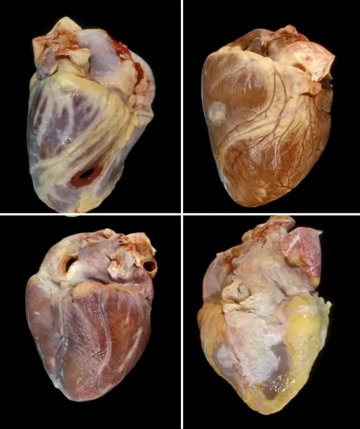 InformaCosmos's tweet photo. 1: Corazón de paciente con herida por arma de fuego.
2: Corazón de paciente con cáncer.
3: Corazón de paciente con sobredosis de cocaína.
4: Corazón de paciente con obesidad. https://t.co/QFHzktWEQj