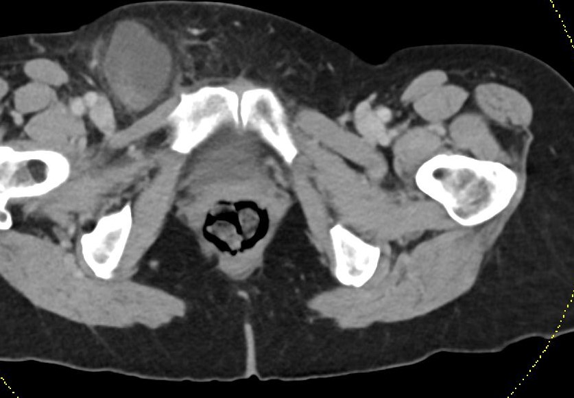 KhuranaBharti's tweet photo. Appendicitis in a strangulated femoral hernia (de Garengeot hernia) #radres #FOAMed #FOAMrad #MedTwitter #medstudenttwitter #EMrad #EDrad @ERadSociety https://t.co/HJHKaPF5gH