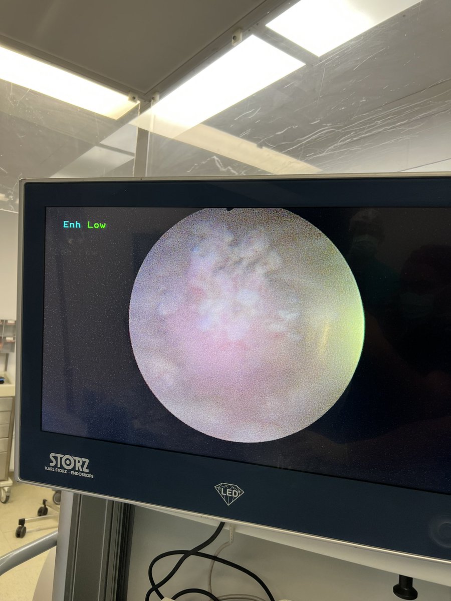 estkorgali's tweet photo. en bloc resection of bladder tumor 👌🏻 #enblocresection #bladdercancer https://t.co/qmMrUGIsDq