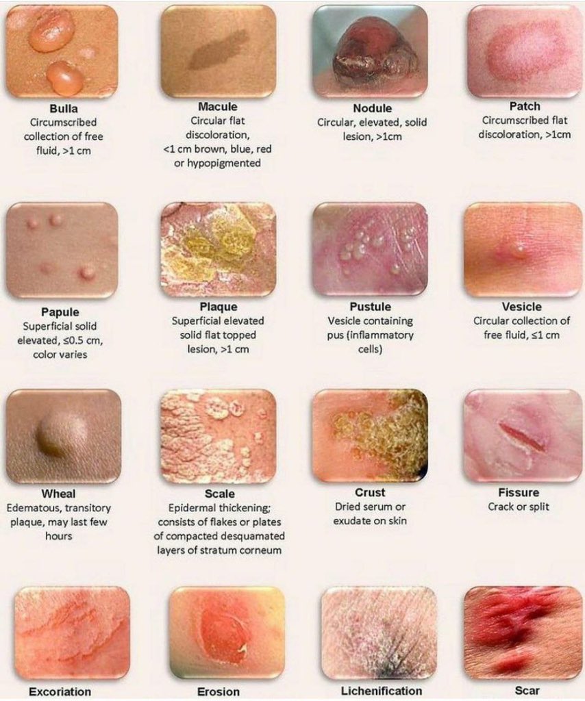 Innov_Medicine's tweet photo. Different types of skin lesions
#skin #meded #medtwitter #INNOMed https://t.co/6t51me7L87