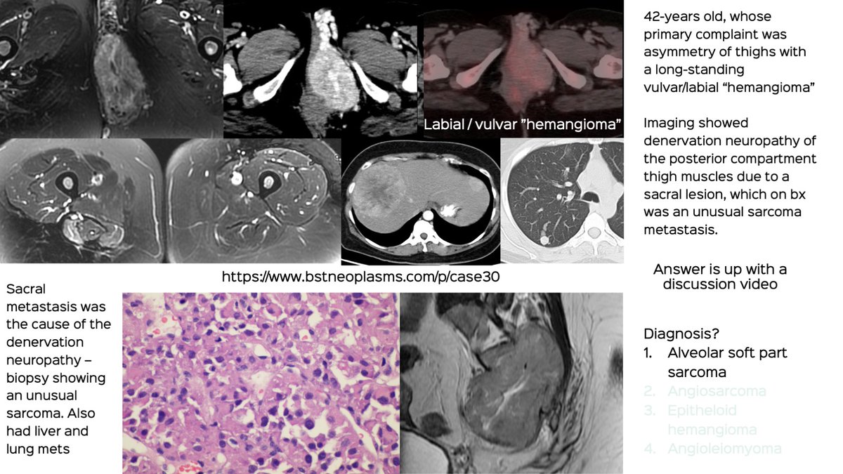 Case 30: The Misdiagnosed Labial Hemangioma. 

The answer is up with a discussion video

bstneoplasms.com/p/case30

#bstneoplasms #bonetumor #radres  #softtissuesarcoma #ASPS #alveolarsoftpartsarcoma