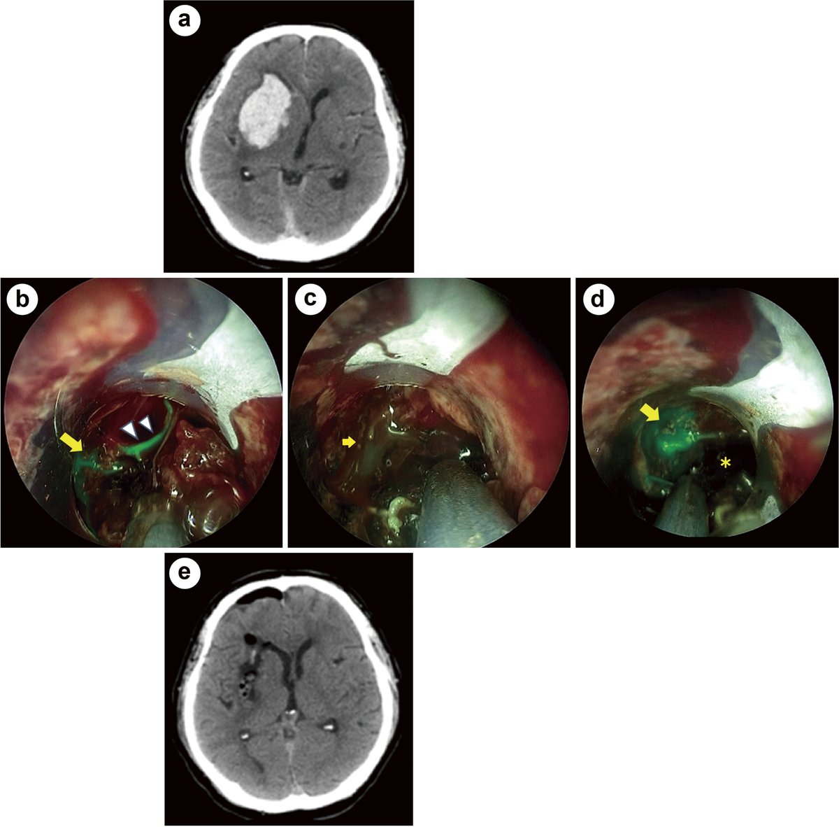 New Arrival: Usefulness of 4K-resolution Indocyanine Green Endoscope for the Removal of Spontaneous Intracerebral Hematomas
doi.org/10.2176/jns-nm…
#Neuroendoscopy(v) #Endoscopy #FluorescenceAngiography #HematomaRemoval #IndocyanineGreen #IntracerebralHemorrhage