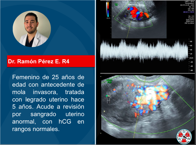 Presentamos el caso de la semana, ¿Cuál es tu impresión diagnóstica? #radres #radiology #ultrasound