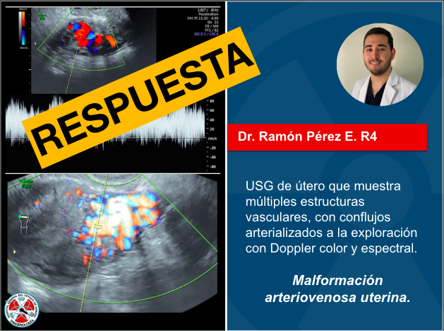 A continuación la respuesta del caso clínico semanal. 
#US #radres #radiology
