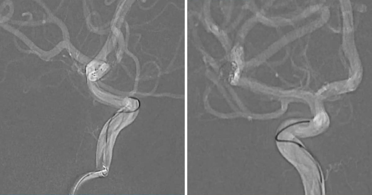 LINNConline's tweet photo. A 46-year-old male patient with a recurrence after coiling of a ruptured #pericallosal #aneurysm is treated by Pr. Farouk Hassan (Cario, Egypt) and his team in this LIVE case. How did the procedure go? Watch now to find out! ➡️ https://t.co/eweSF18u9L https://t.co/zNNbVj4JMN