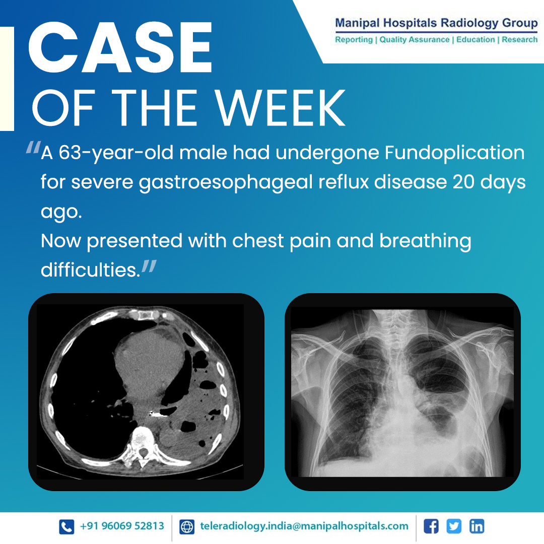 ManipalMhrg's tweet photo. Presenting our #CaseOfTheWeek - A 63-year-old male had undergone Fundoplication for severe gastroesophageal reflux disease 20 days ago.
For more read on: https://t.co/ulBloaTGVt
#radiologyy #teleradiology #MHRG #subspecialty #CaseOfTheWeek https://t.co/unkw1wanlb