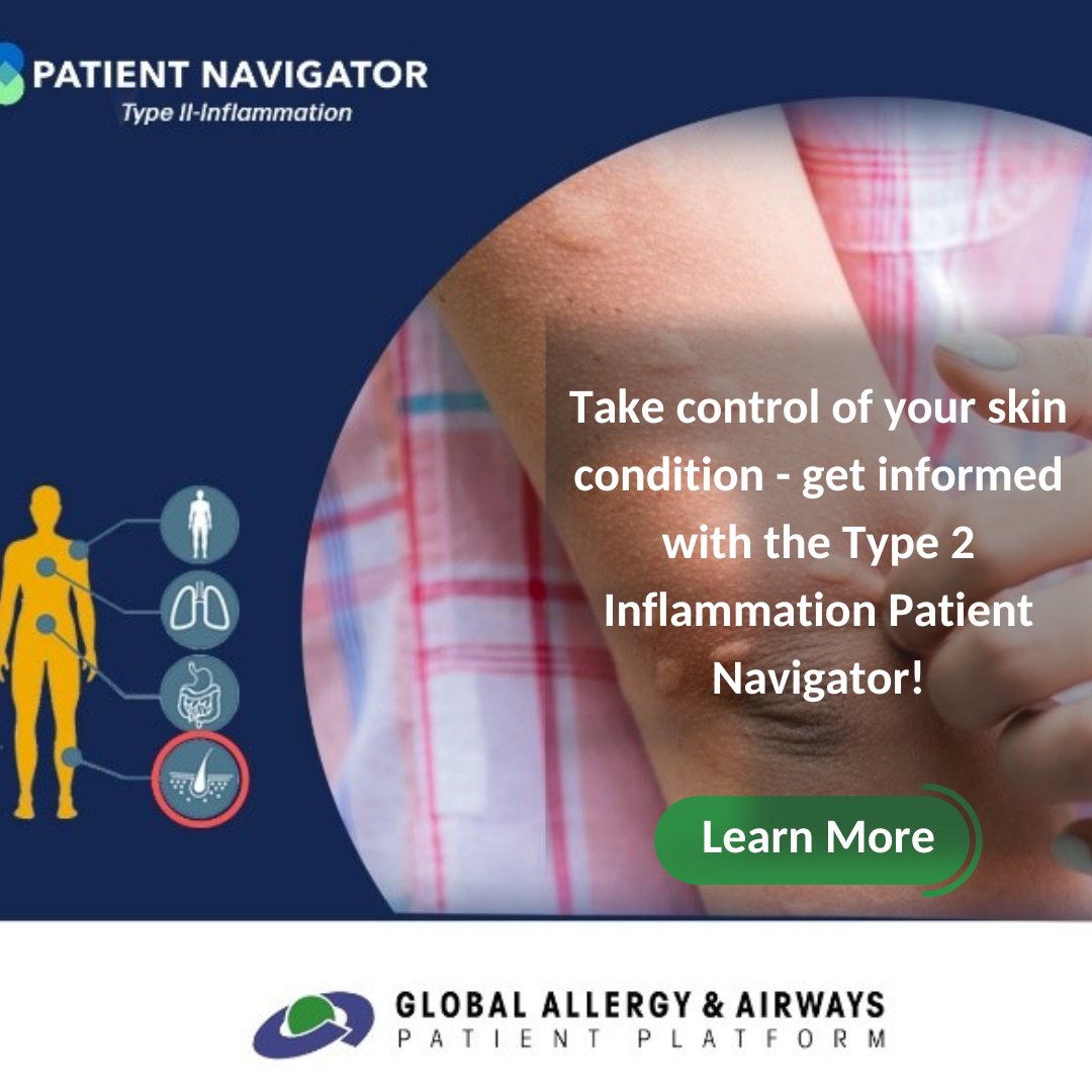 #ChronicSpontaneousUrticaria (CSU) is a skin condition characterised by lesions on the skin. CSU can also be eosinophilic driven! Learn more on the Type 2 Inflammation Patient Navigator and check out the virtual stand. #T2IPN: Learn more: ow.ly/iafU50MroKU #skin #patient