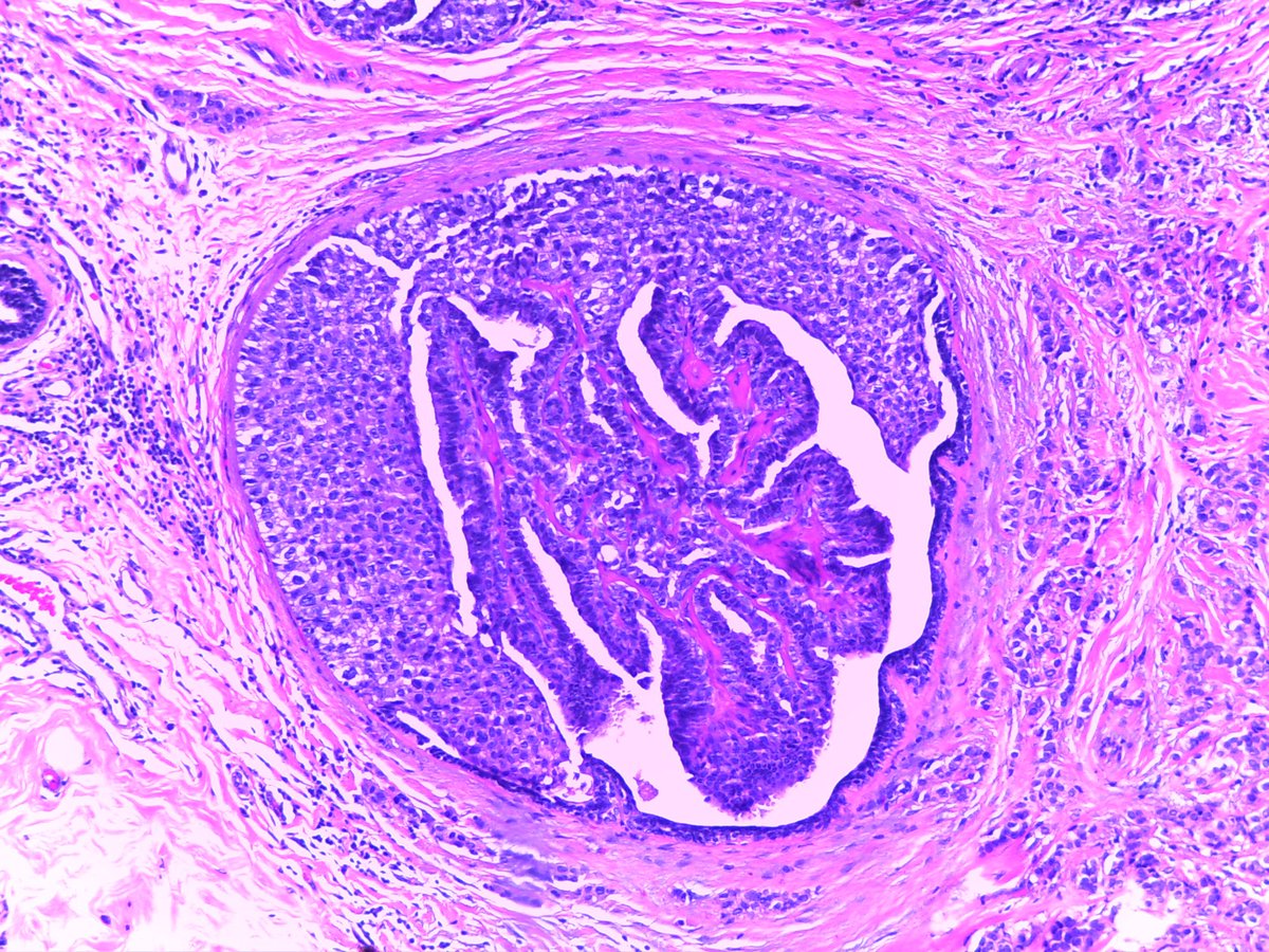 #BreastPath